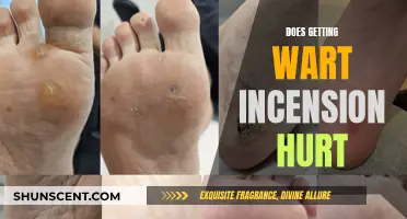 Wart Incension: Does the Procedure Hurt?