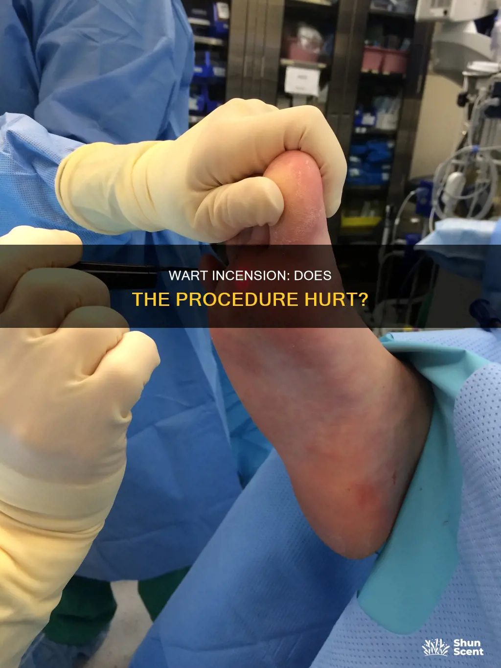 does getting wart incension hurt