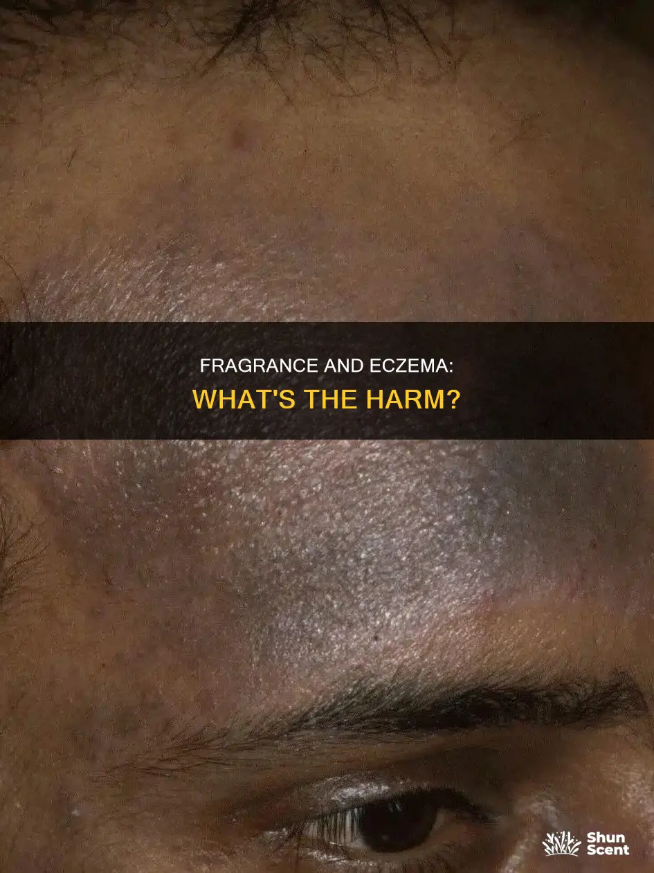 is fragrance bad for eczema